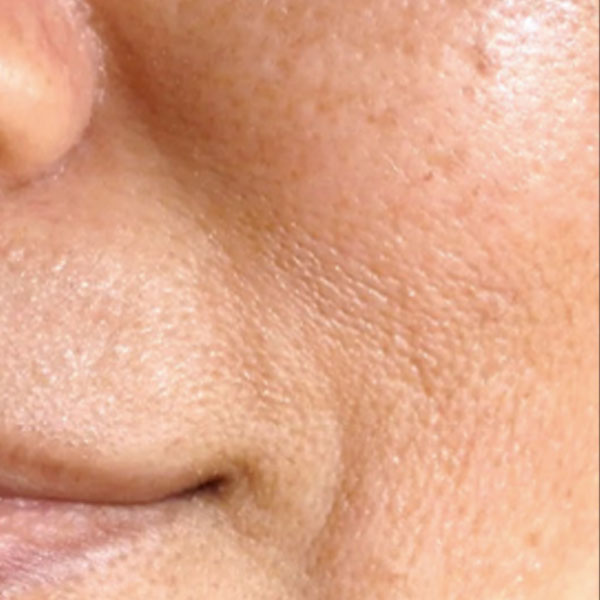 Pelle iperpigmentata